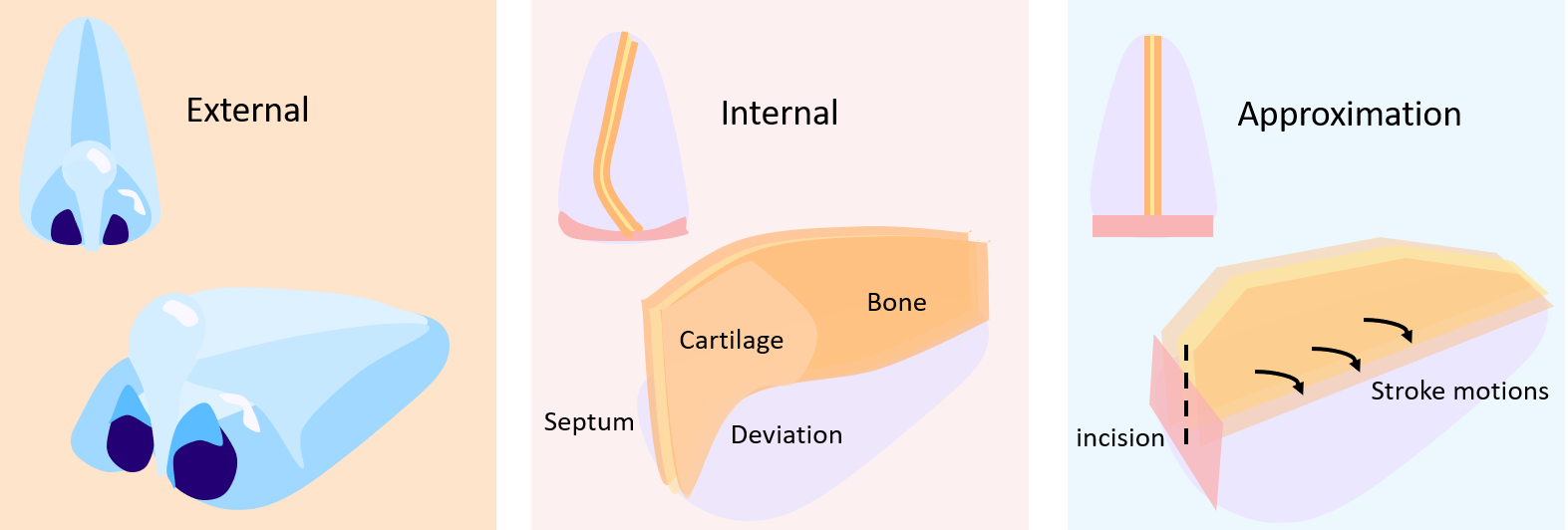 Nasal Septoplasty – AI for Surgery Lab at JHU